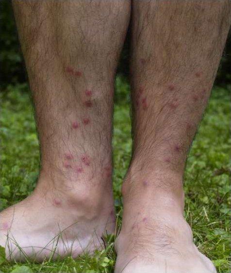 Clinical Presentation swimmer s itch most often occurs 2 to 3 days after invasion as an itchy maculo-papular rash on