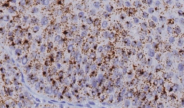 METHODS Tissue microarray (TMA) constructed Immunohistochemistry and HPV detection performed RNAscope E6/E7 mrna Detects