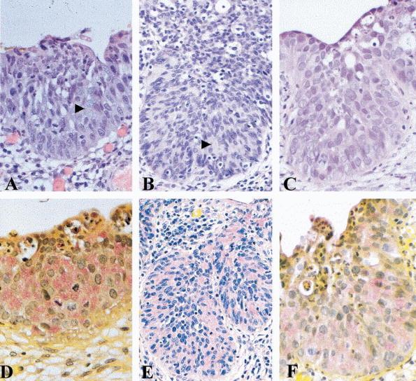Stratified Mucin-Producing Intraepithelial Lesions of the Cervix: Adenosquamous or Columnar Cell Neoplasia?