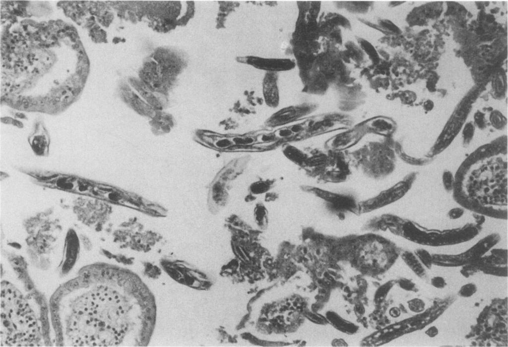 124 CROSS CLIN. MICROBIOL. REV. FIG. 7. Human intestinal tissue at autopsy showing multiple histologic sections of C. philippinensis. Female worms with eggs in the uterus are visible.