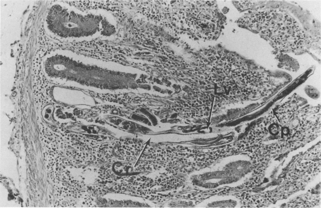 Electron micrographs of biopsied jejunal tissue showed loss of adhesion specialization and widespread separation of epithelial cells.