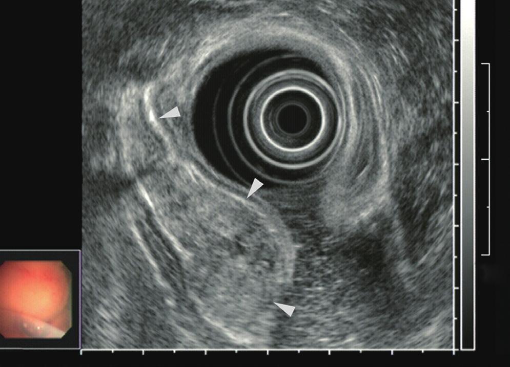 () Endoscopic ultrasonography shows a heterogeneous hypoechoic tumor in the third layer of the gastric wall (arrowheads). tiated adenocarcinoma) (Fig.