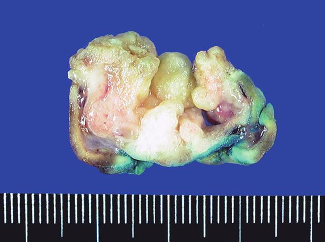 Multifocal denocarcinoma within Gastric IHP 389 Muscularis mucosae Hyperplasia Dysplasia denocarcinoma m sm sm m C D E F G H I Fig. 2.