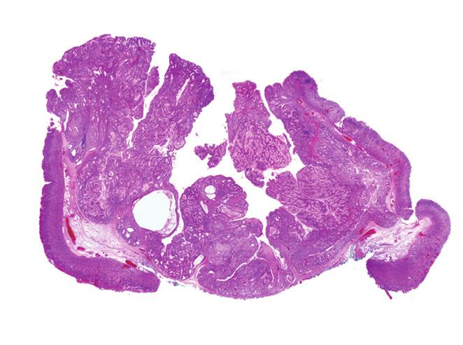 differentiated adenocarcinoma (H).