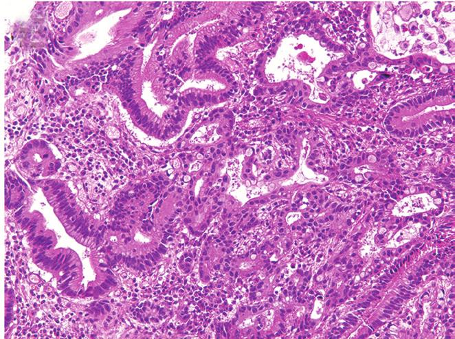dysplastic component. gastric HPs that undergo malignant transformation are accompanied by well- to moderately differentiated adenocarcinomas.