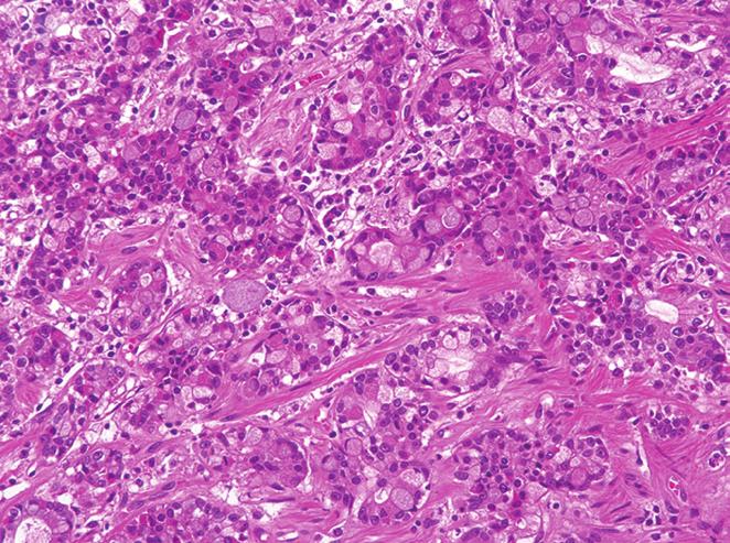 10-12 To our knowledge, this is the first report of a signet ring cell carcinoma that arose within a gastric IHP.