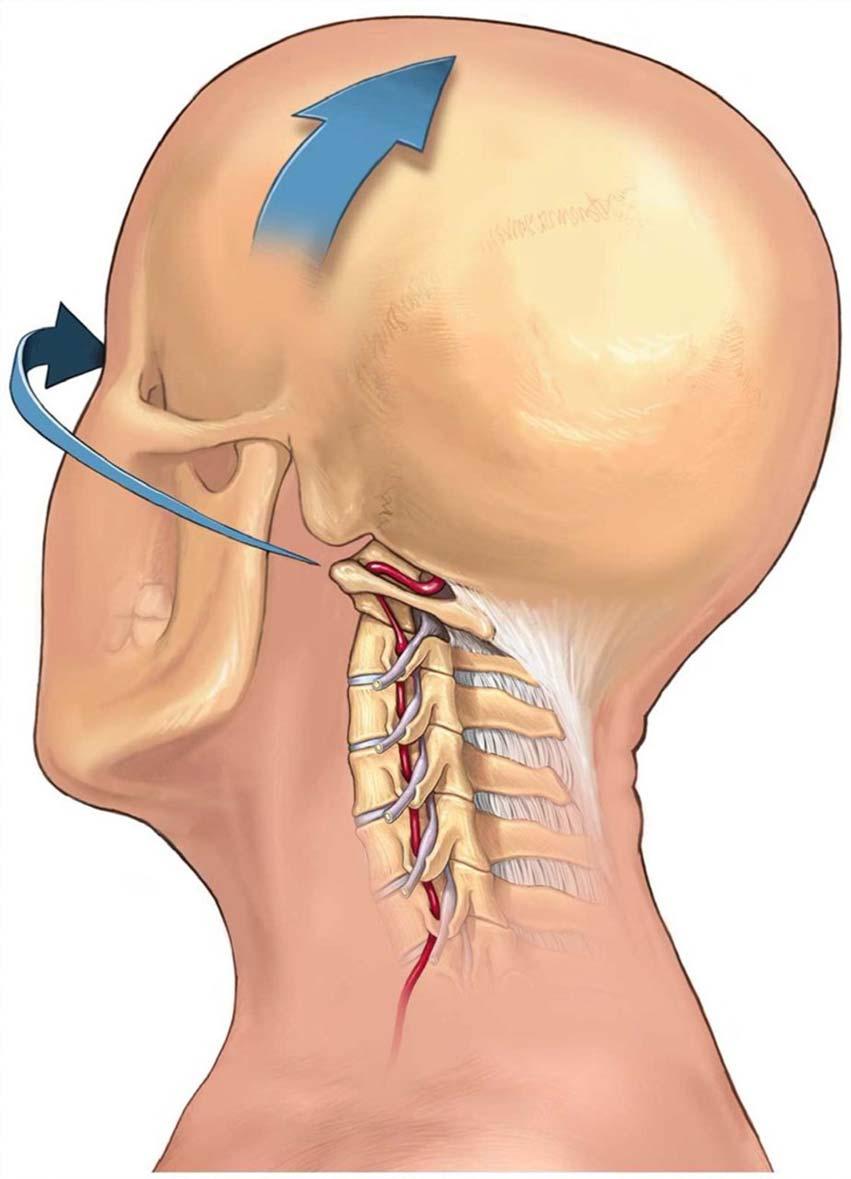 The vertebral artery as it passes through the transverse foramina of C6 through C2 and then enters the skull base through the