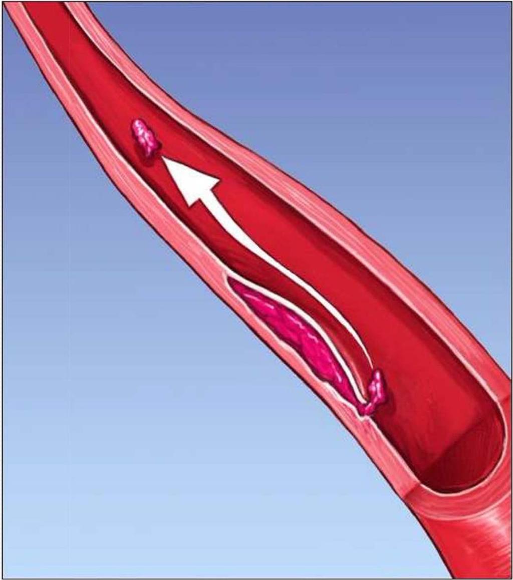 Thrombus from a nonocclusive dissection becoming dislodged and embolizing downstream.