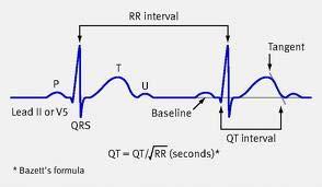 Intervals What is a normal PR interval? 0.12 to 0.20 s (3-5 small squares). Short PR watch out for accessory pathways Long PR AV block bundle of his disease What is a normal QRS? < 0.