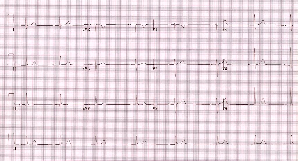 Case #1 ECG Rate: HR: 45 bpm. Bradycardia Rhythm: Regular. Axis: Normal Hypertrophy: LVH Intervals: Prolonged PR interval 240 ms 1 st degree AV block.
