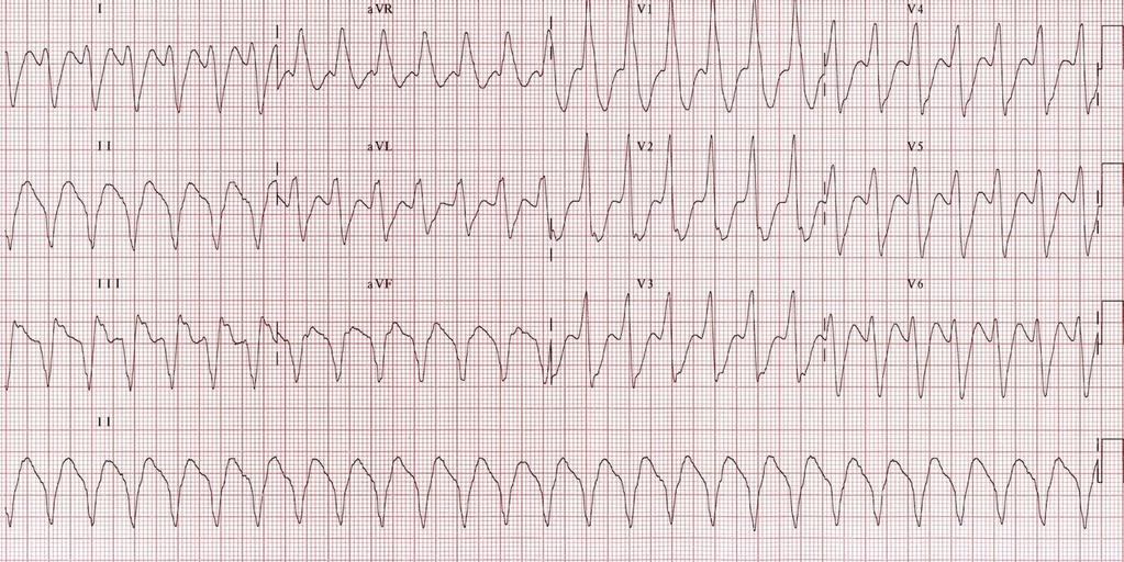 Case #3 ECG Answer: Monomorphic V Tach. Interns should recognize this immediately as a life threatening emergency. Begin ACLS Rate: HR 150. Tachycardia. Rhythm: Any P- waves present?