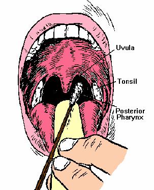 The patient should try to resist gagging and closing the mouth while the swab touches the back of the throat near the tonsils.