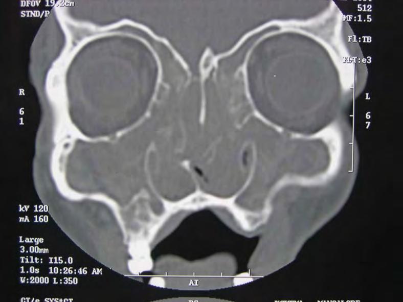 DPRSP CT homogenous opacity of all sinuses Commonly seen in Aspirin Sensitivity Asthmatics