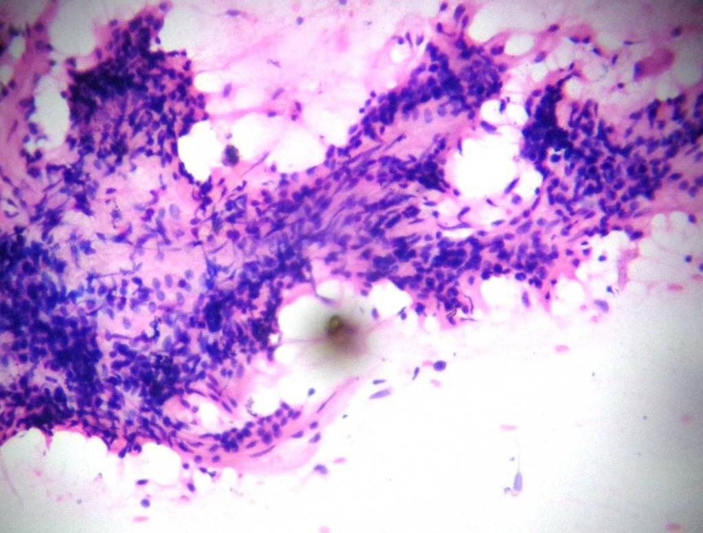 cells in clusters with background of fibrillary chondromyxoid ground substance which was concluded as benign mixed cell