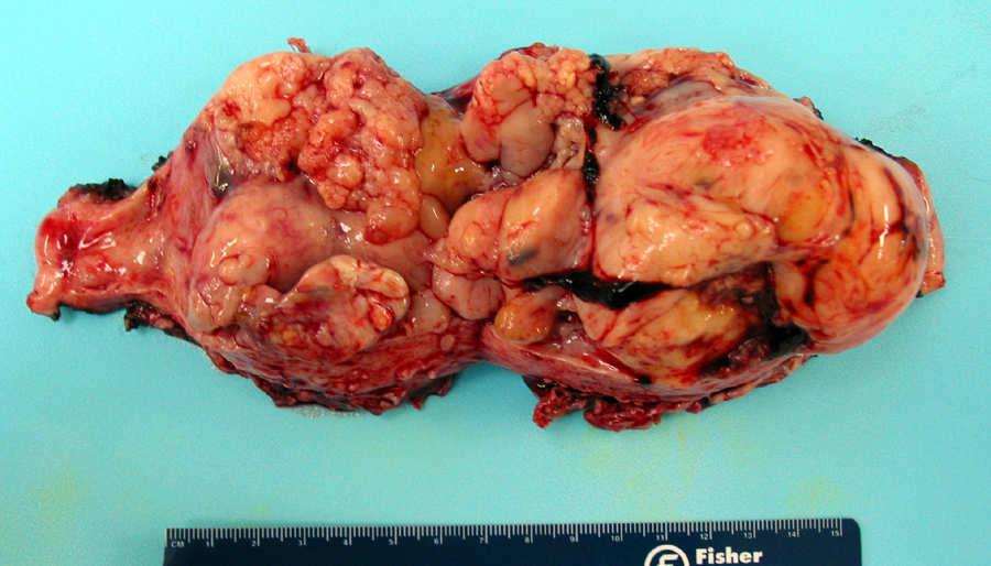 Müllerian Adenosarcoma Low grade müllerian tumor with a biphasic growth of benign or atypical epithelium and malignant stroma (usually low grade sarcoma) Uterus >