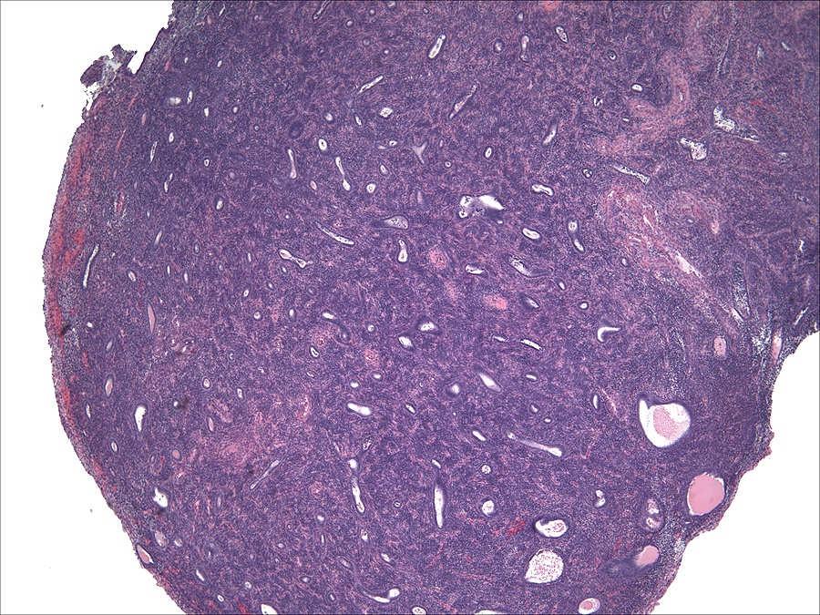 Endometrial Polyp with Cellular Stroma