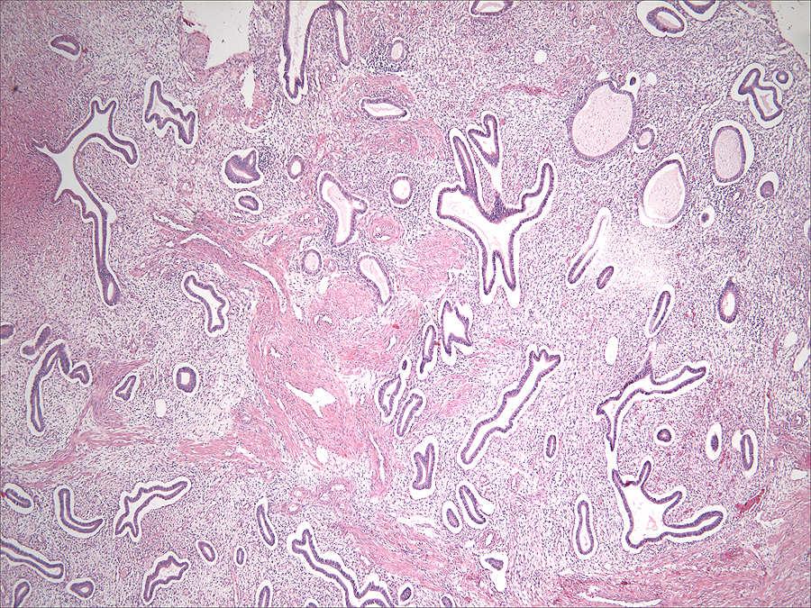 Uterine Corpus Endometrial polyp with