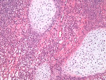 Carcinosarcoma Clinical Features Most common type of