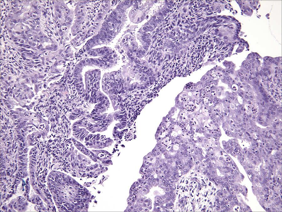 carcinoma Non-cohesive undifferentiated component juxtaposed to well