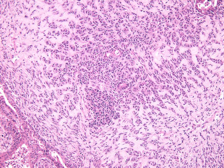 MMMT/Carcinosarcoma Differential Diagnosis Spindled endometrioid carcinoma Merging of spindled