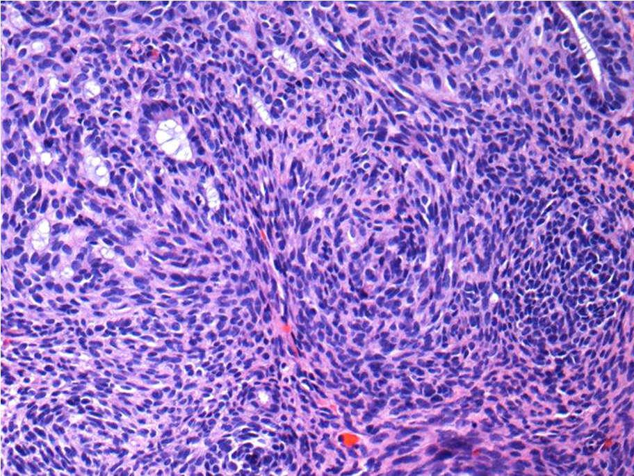 heterologous component MMMT/Carcinosarcoma Differential Diagnosis Mullerian adenosarcoma with