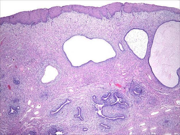 Adenosarcoma Little to no smooth muscle Intracystic papillary projections