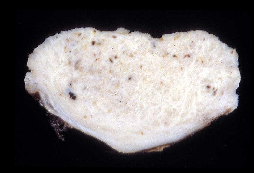 Myomatous Endometrial Polyp