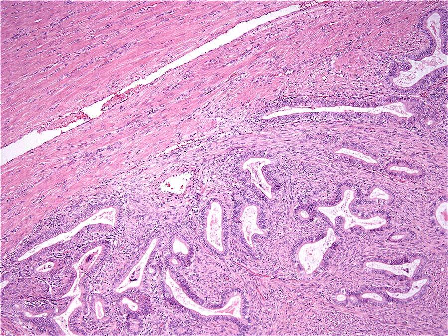 Adenomyoma Gross Features Typically located in lower uterine segment Usually solitary and well circumscribed