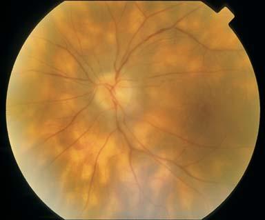 7.3 HLA Associations with Ocular Inflammatory Disease 97 Fig. 7.1.