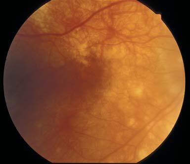 7.3 HLA Associations with Ocular Inflammatory Disease 99 Fig. 7.2. Peripheral retina of a Mestizo individual with Vogt-Koyanagi disease in the chronic phase showing retinal pigment epithelial changes.