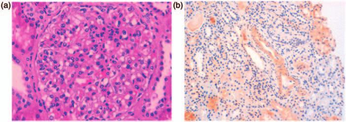 1457 Figure 2 (a) Segmental and difuse mesangial proliferation (HE 400). (b) Amyloid deposits in the media, with anti-ttr positive (TTR 200).