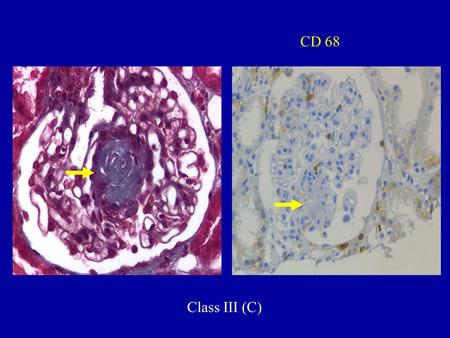 Slide 7 Ok, here is a very important topic. Class IV involving more than 50% of glomeruli.