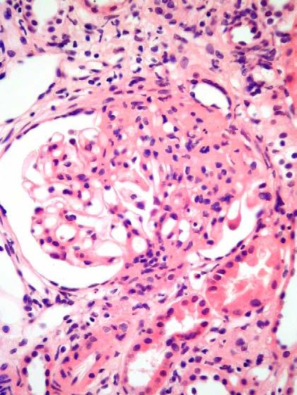 nephrotic syndrome is associated with focal segmental glomerular lesions the