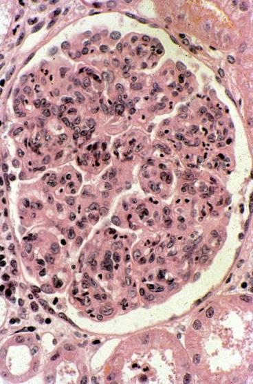 Acute Proliferative (Poststreptococcal, Postinfectious) GN Pathology: light microscopy: enlarged, hypercellular
