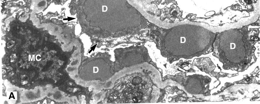 Which statement regarding the disease depicted on electron micrograph below is INCORRECT: A. This disease has poor prognosis B.