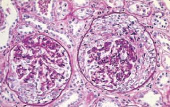 Look at biopsy slides below. Which statement about this disease is INCORRECT: A.