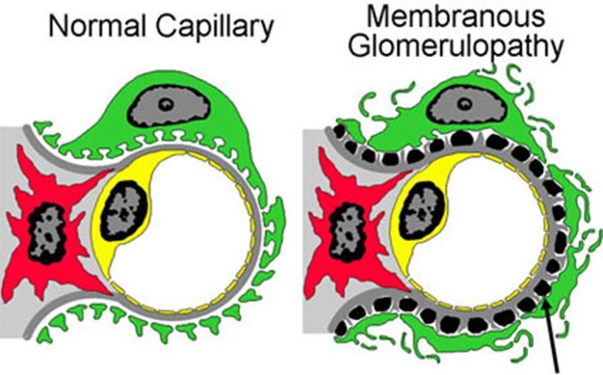 Membranous Glomerulonephropathy Definition: Histopathologic lesion characterized by glomerular