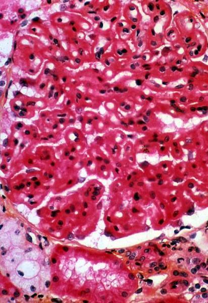 Membranous Glomerulonephropathy Pathology: light microscopy: diffuse, uniform thickening of