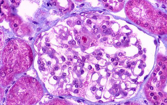 IgA Nephropathy normal LM: Mesangial