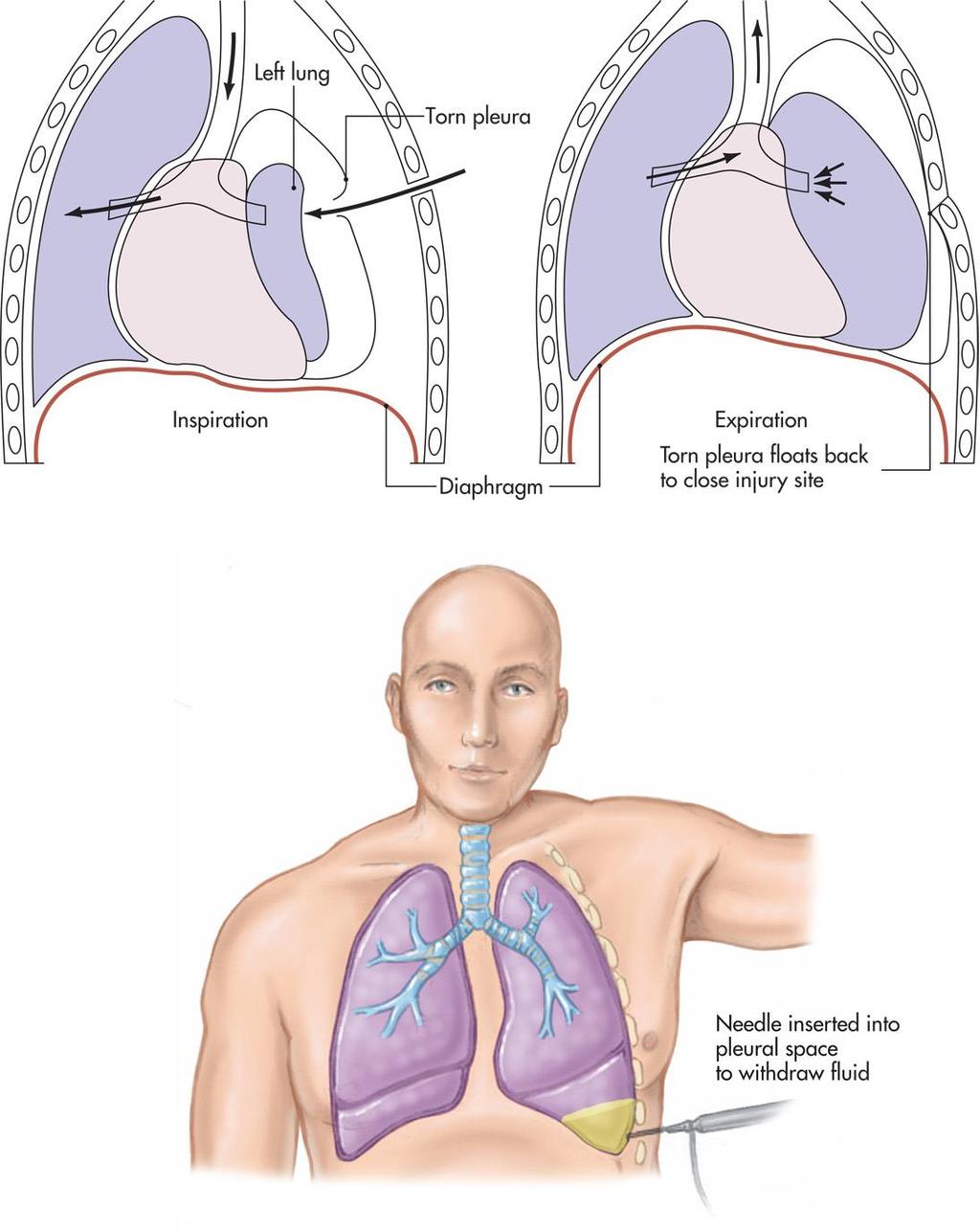 Figure 13-16 Pneumothorax (sucking chest