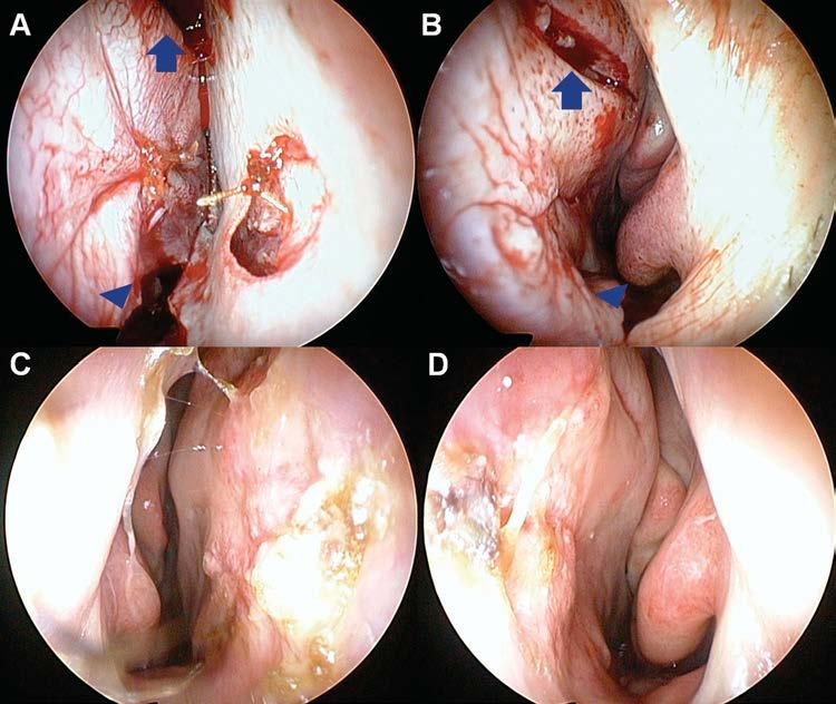 Figure 1. Bipedicled advancement flaps were used to close the medium-sized perforation. (A) Bilateral flap closure with 5-0 chromic gut and the defect of the septal are observed.