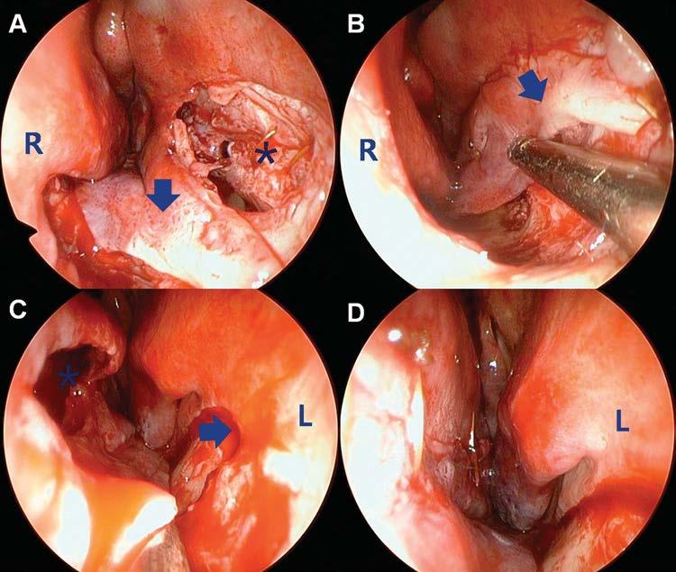 Figure 3. (A) On the right nasal cavity, a large perforation is observed on the cartilaginous septum (asterisk) and a inferoposteriorly based rotation flap (arrow) is being elevated.
