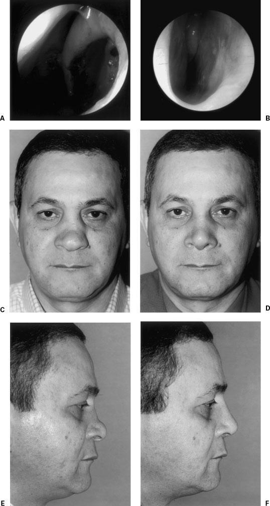 COMBINING RHINOPLASTY WITH SEPTAL PERFORATION REPAIR/FODA, MAGDY 285 Figure 3 (A) A 45-year-old male with a huge (3 cm) septal perforation.