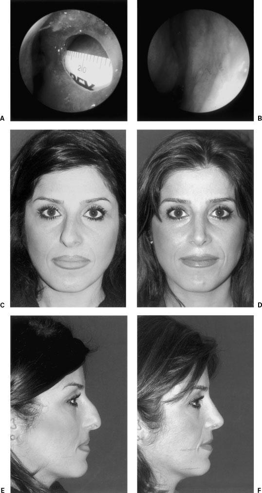 286 FACIAL PLASTIC SURGERY/VOLUME 22, NUMBER 4 2006 Figure 4 (A) A 34-year-old female presenting with a 2-cm septal perforation and (C, E) coexisting external deformities that are unrelated to the