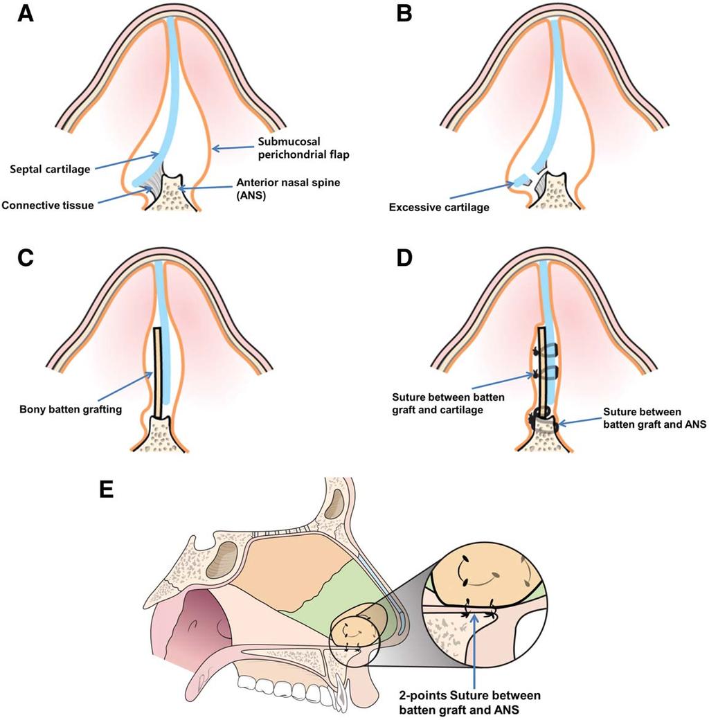 Fig. 1. After (A) bilateral flap elevation, (B) the excessive septal cartilage and bone was resected. (C) A caudal septal batten graft was fitted to the desired location.