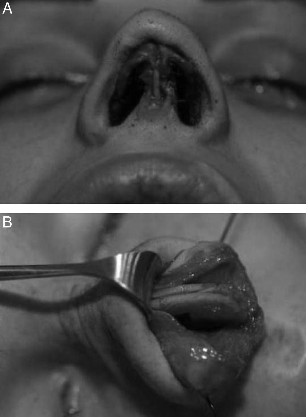 time-consuming because fewer supporting structures need to be severed, thereby reducing the risk of postoperative loss of stability of the middle and lower third of the nose compared with septal