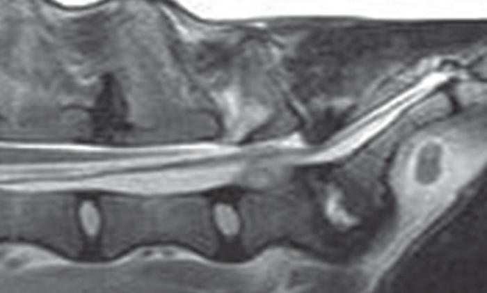 Figure 11. Sagittal T2-weighted MRI of the lumbosacrum of a boxer dog with lumbosacral discospondylitis.