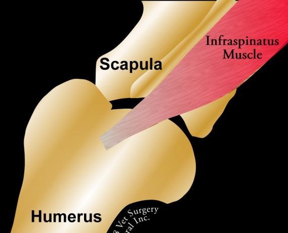 Infraspinatus Muscle Contracture Anatomy