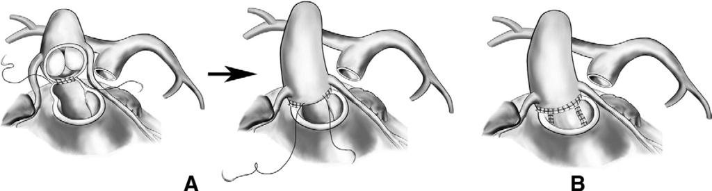 atrioventricular valves. It also allows for a more precise closure of the VSD in patients with a straddling atrioventricular valve.