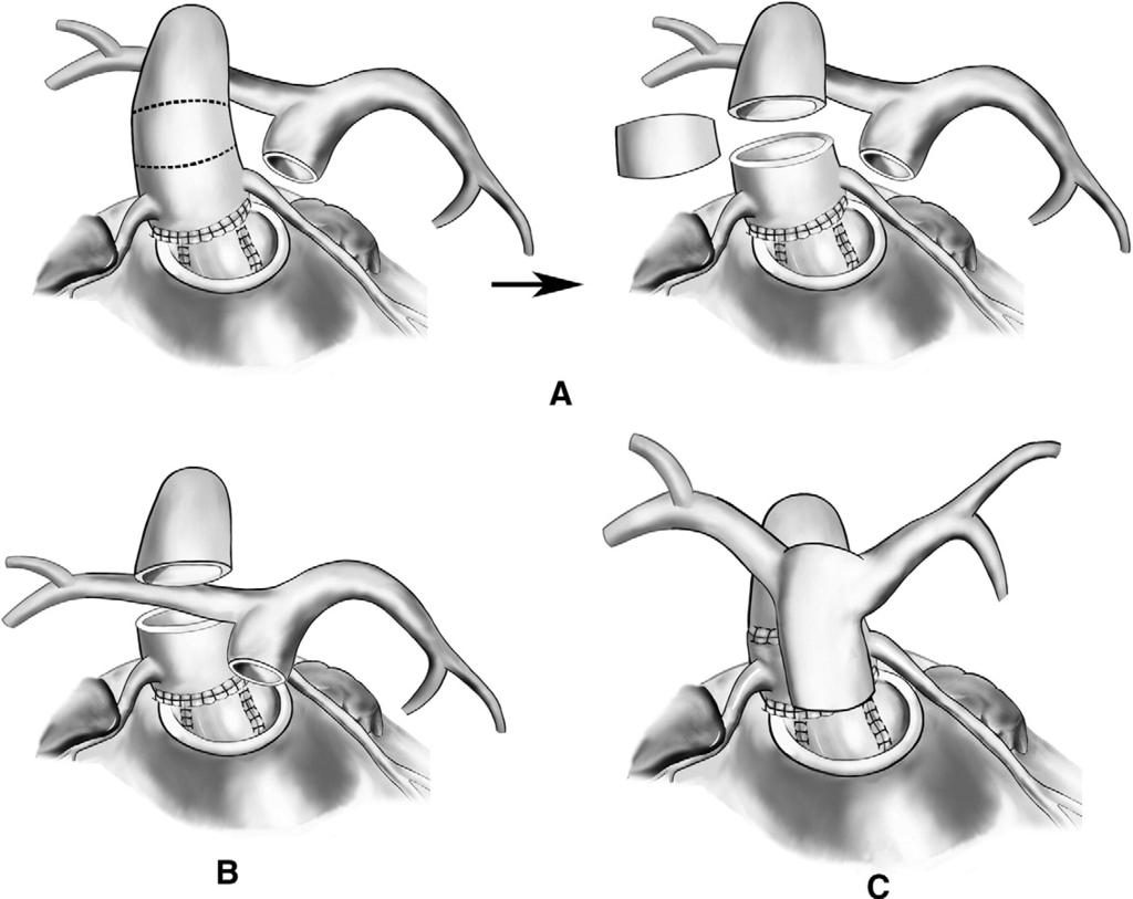 Technique of aortic translocation 185 Figure 6 (A) After aortic cross-clamping, the mid-ascending aorta is transected and a segment of aorta is excised to prevent posterior compression of the